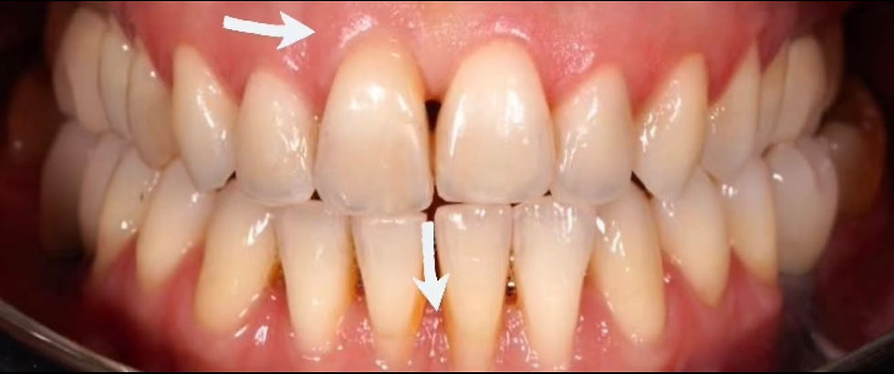 Dinții n-au crescut. De ce apare retracția gingivală?