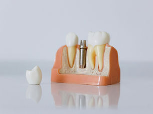 Implantul dentar: rădăcina invizibilă care ține totul
