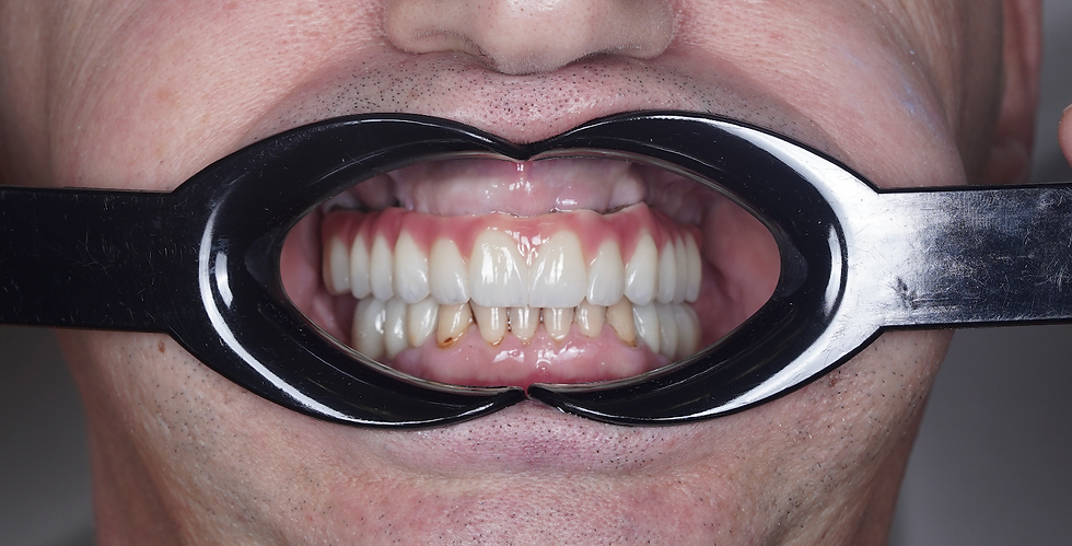 Prim-plan cu gura unui pacient, dinți expuși cu un depărtător dentar negru; zâmbet neutru, fundal gri.