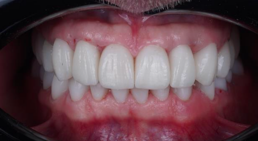 Prim-plan cu dinți albi într-un depărtător dentar, gingii roz și fundal negru, aspect clinic.