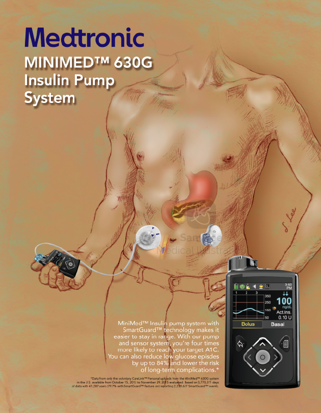 Medical Device Ad - Insulin pump