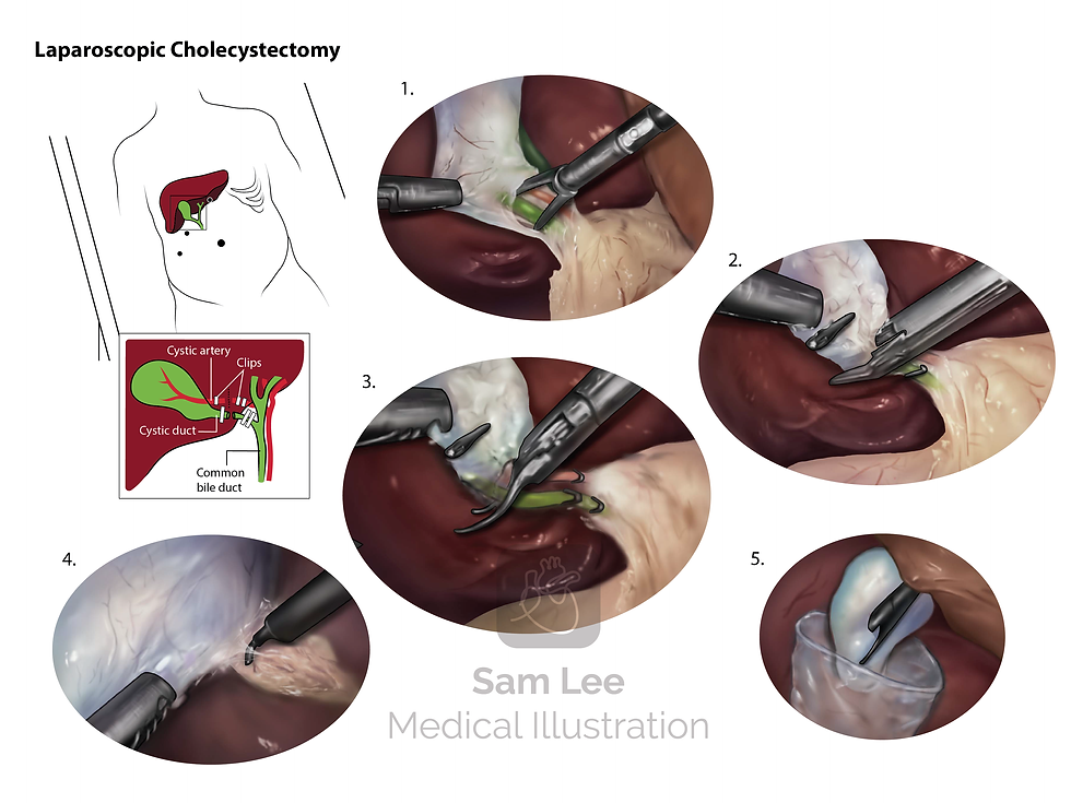 Laparoscopic Cholecystectomy