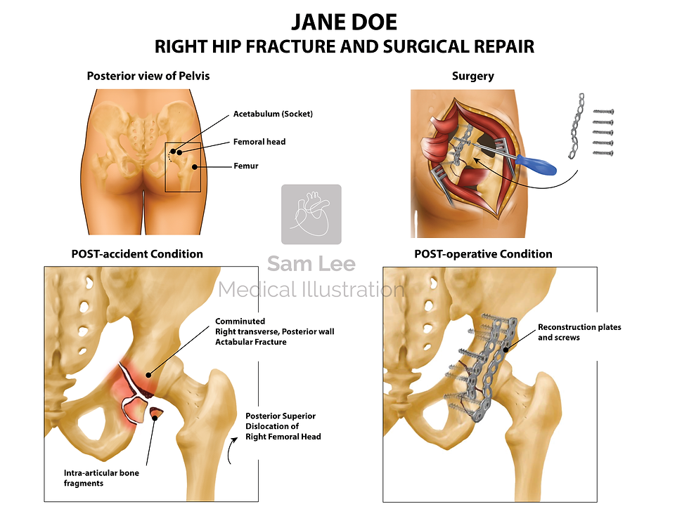 Right hip fracture and surgical repair