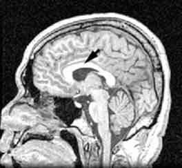 Slika 1. Corpus callosum je deo mozga koji spaja hemisfere i koordiniše njihov rad.