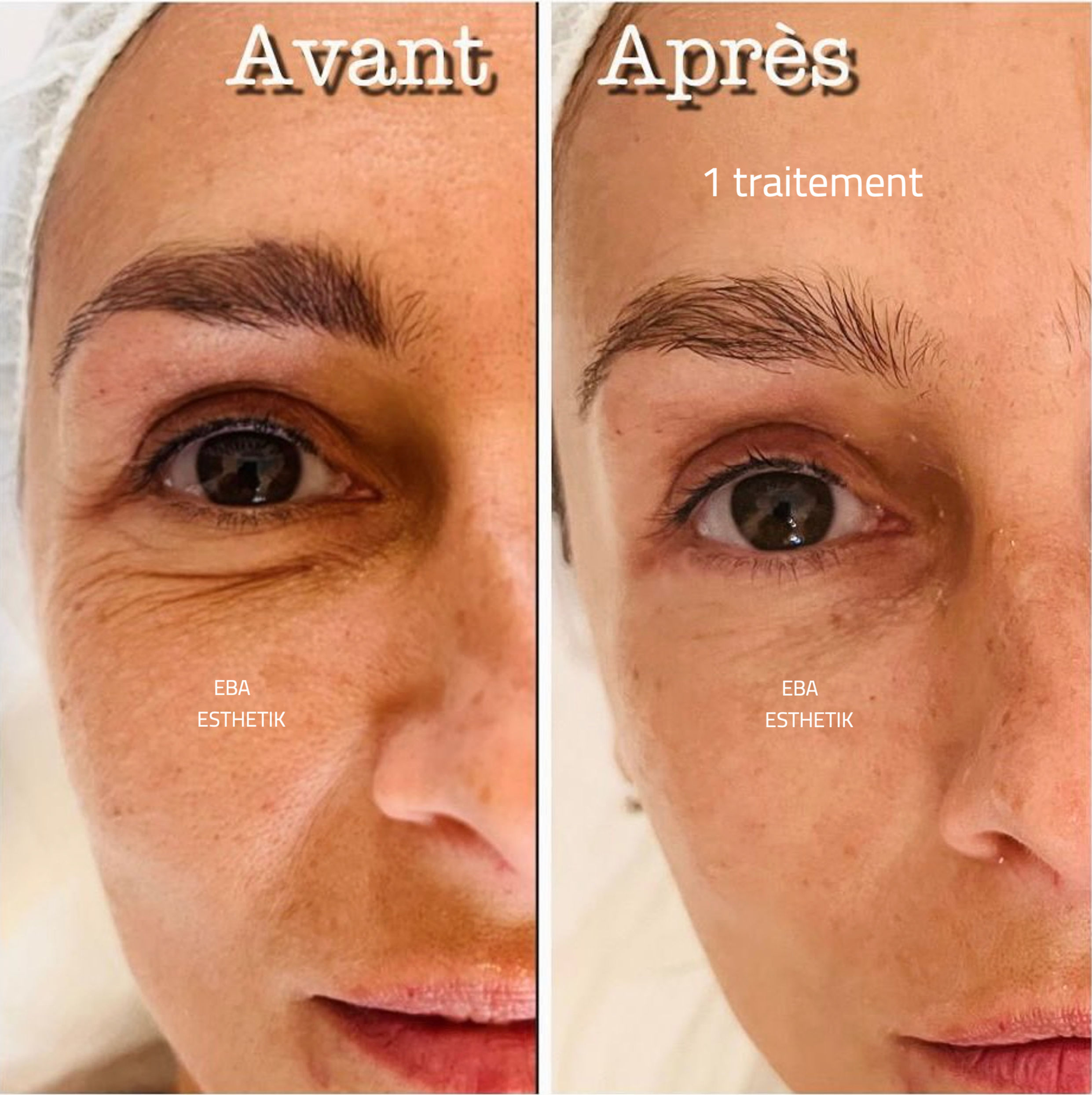 Formation Lifting coréen