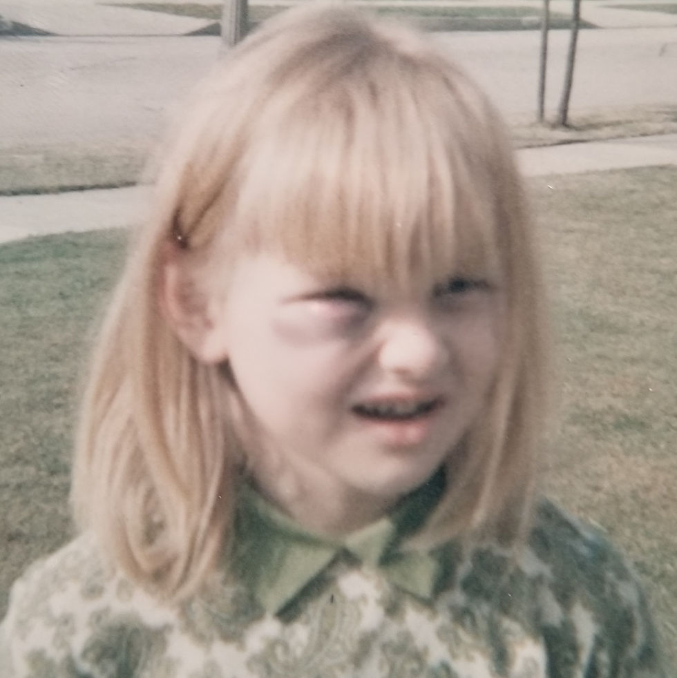 Rhonda Sciortino with a black eye 7 years old