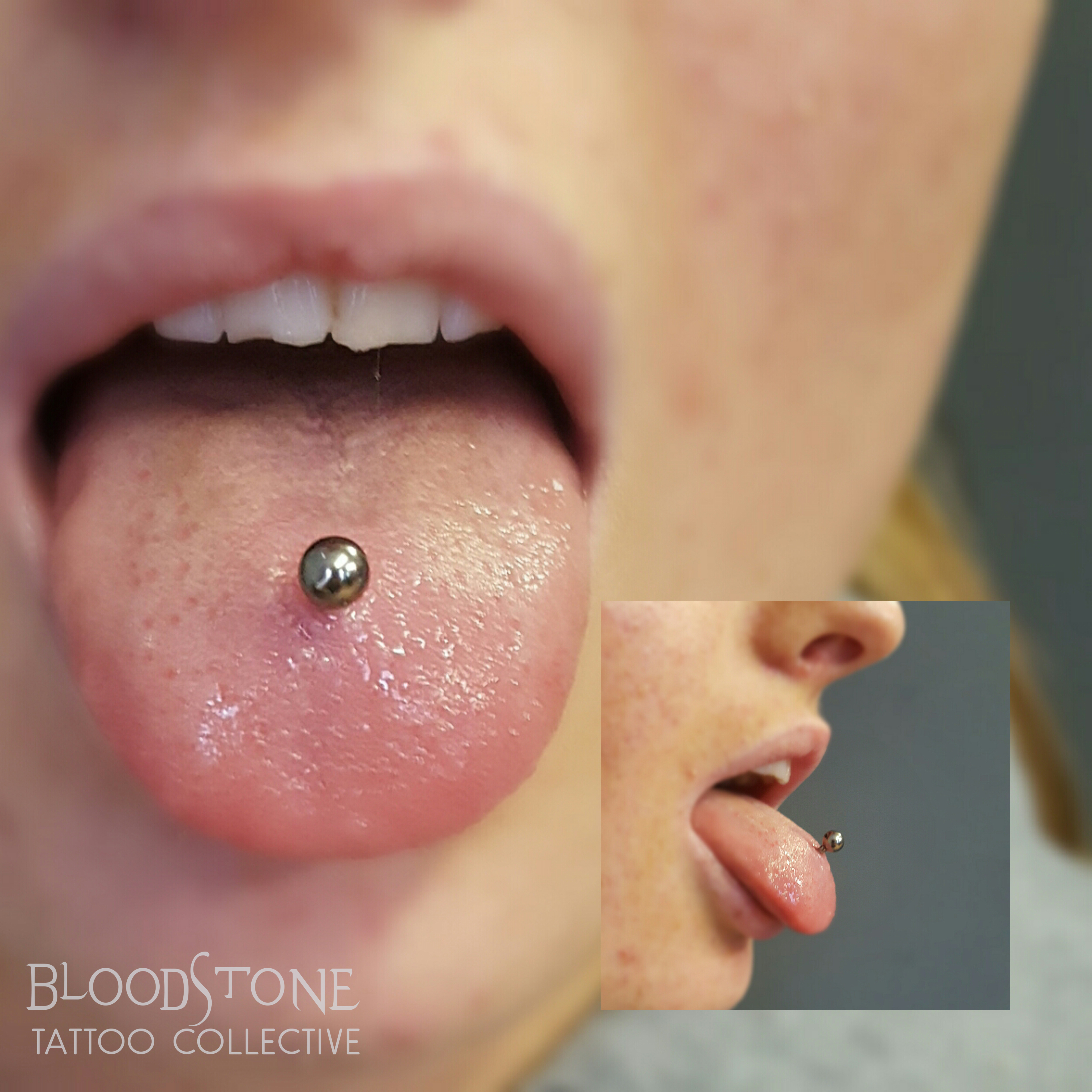 Healed tongue piercing