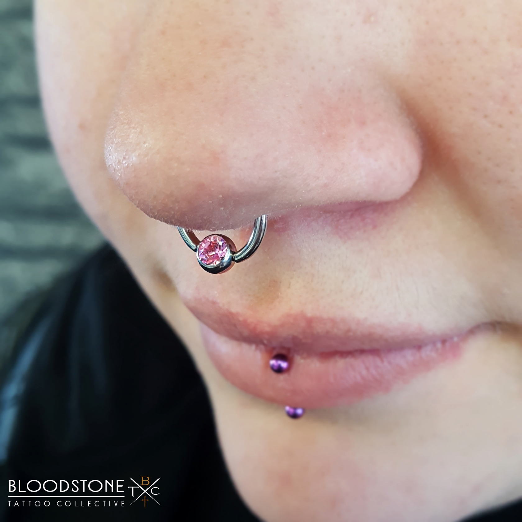 Healed Septum