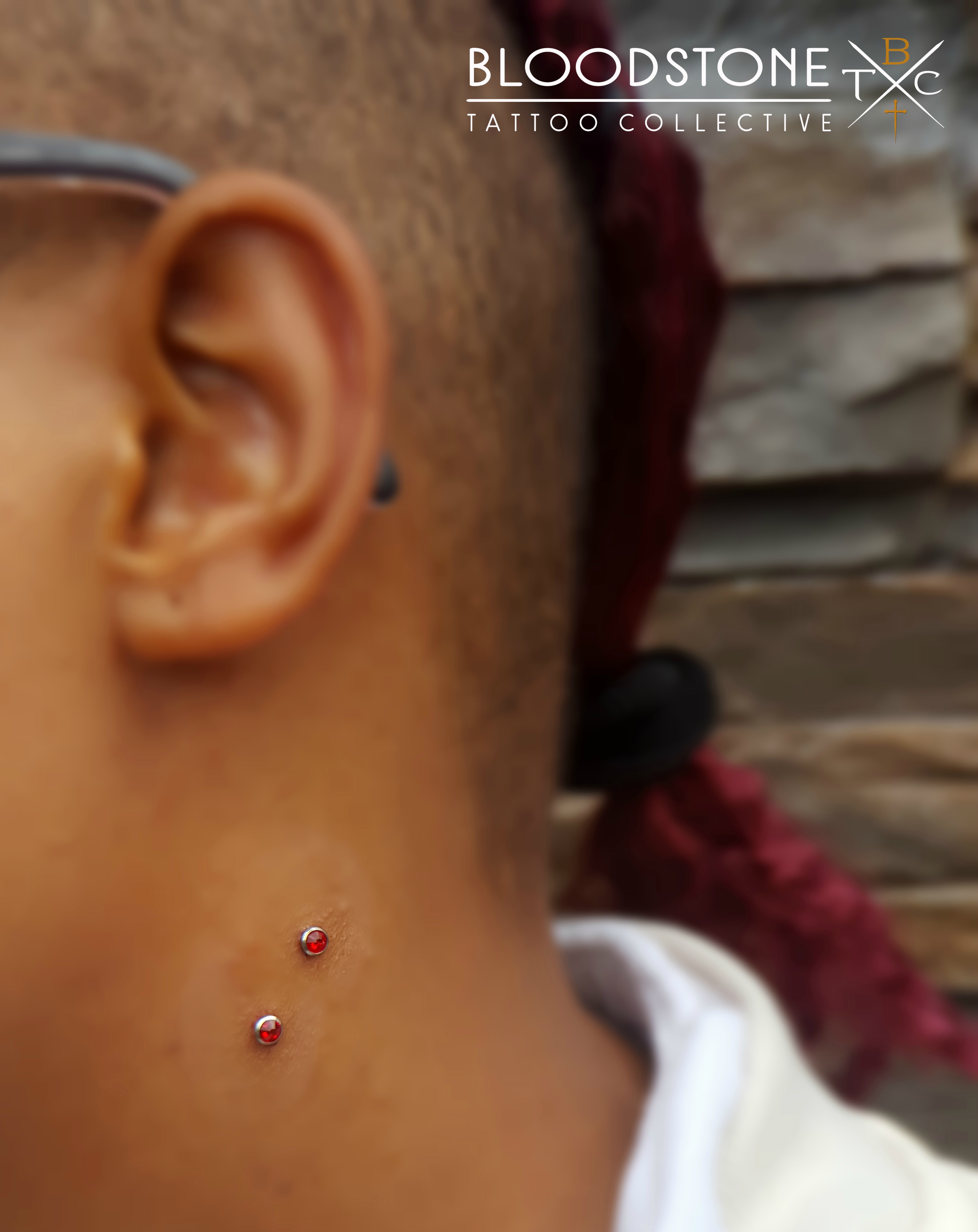 Dermal implant vampire bites