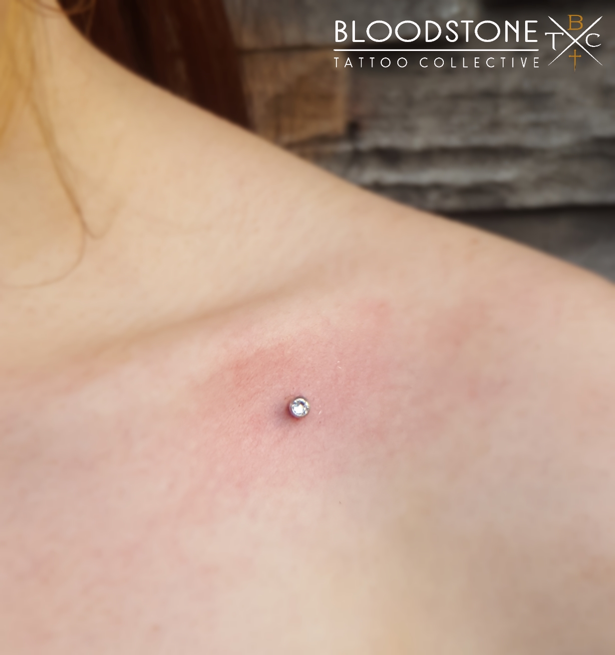 Single Dermal in Collarbone
