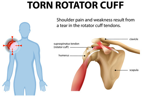 cuff injuries