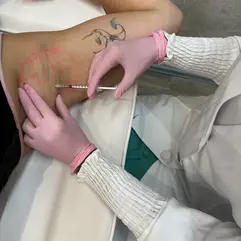 Fisioterapeuta aplica Botox nas axilas no Bio Studio, Porto Alegre, para reduzir suor excessivo.