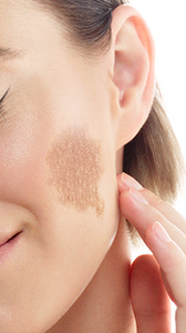 Manchas de pele
Hipercromia
Melasma