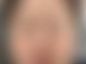 フェイシャル脱毛