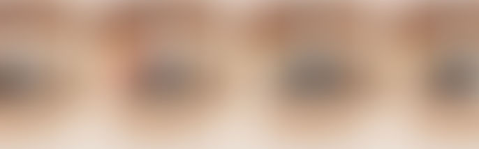 Thực tế cắt góc mắt có phá tướng không?