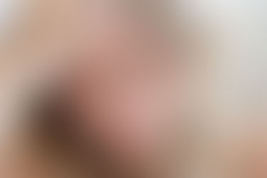 Muốn khắc phục mí mắt bị sụp làm gì bây giờ?