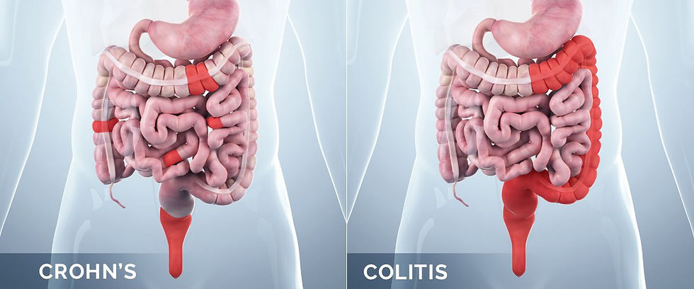 Crohn-Colite.jpg