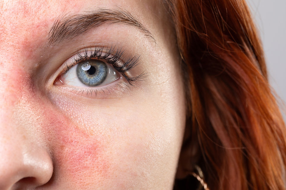 Effective Rosacea Treatment Nottingham