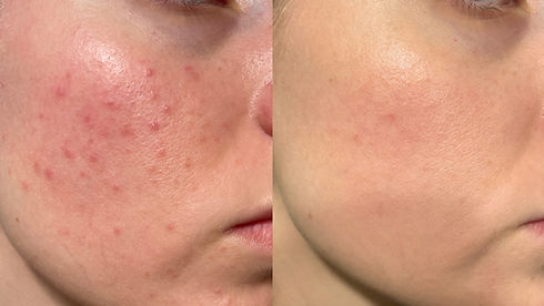Acne scars treatments with mesotherapy
