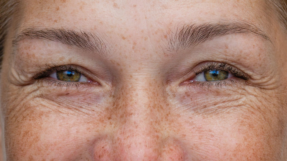 Facial microneedling treatment in a Nottingham skin clinic.