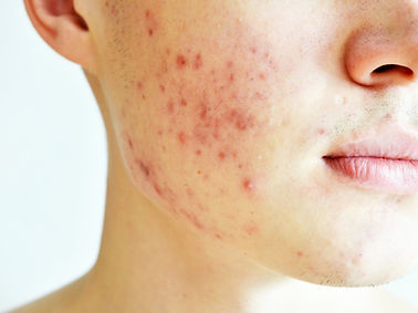 Acne skin treatments in Nottingham