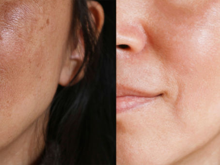 Skin transformation by KA – The Skin Expert near the Nuffield NG3 area: Microneedling and brightening serum results for uneven skin texture and dark spots