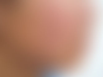 Bespoke Acne Treatment With Gut-BloodTesting 