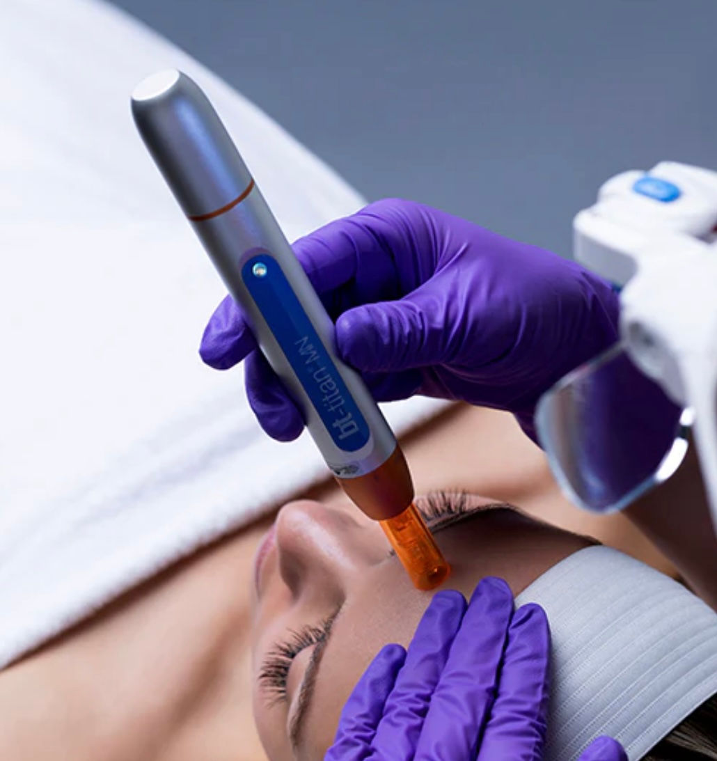 Microneedling treatment in Nottingham to improve skin texture and enlarged pores.