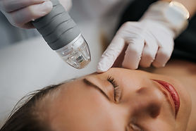 Medical Microneedling In Nottingham