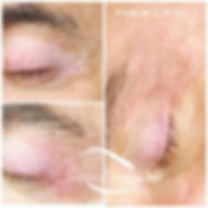 Correzione Vitiligine perioculare