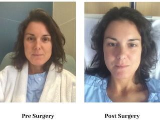 Breast Implant Illness, Breast Explant Story