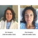 Breast Implant Illness, Breast Explant Story