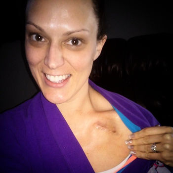Instagram - My little engine that can! #Biotronik #pacemaker #vasovagalsyncope #