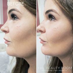 1.1ml Chin Enhancement
