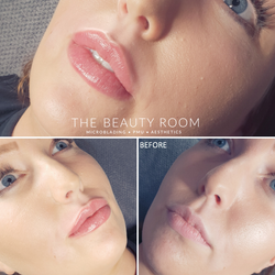 1ml Revolax Lip Enhancement