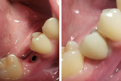 Implante dentário sendo realizado pelo Dr. Alexandre