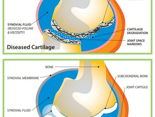 Osteoarthritis
