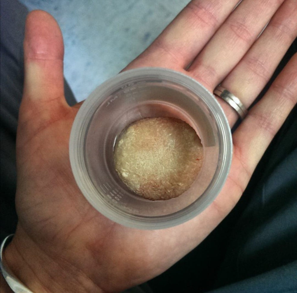 Bladder stones and obstructions