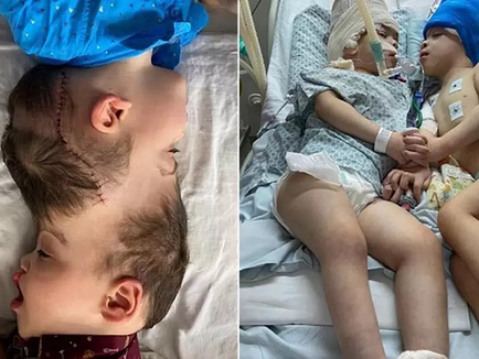 Virtual Reality Used in Separating Conjoined twins in Brazil