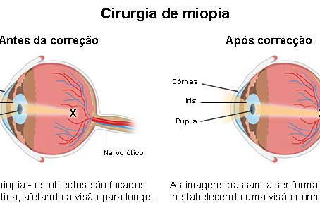 Cirurgia de Miopia: LASIK, PRK e Lentes Intraoculares