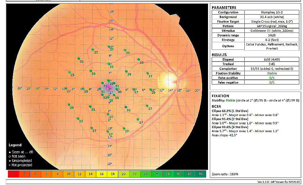 ptose palpebral, olho caído