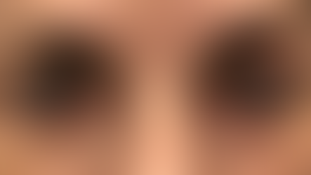 Ptose palpebral (pálpebra caída)