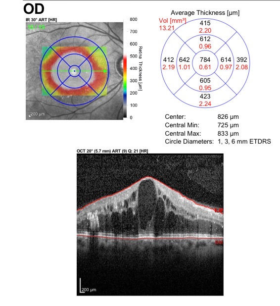 retinopatia diabética