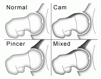 normal cam pincer misto