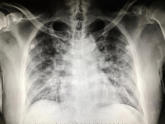 Problems with the lungs, often caused by serious lung infections, are the most common cystic fibrosis complications.