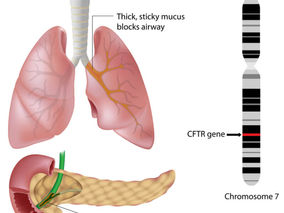 Galapagos Cystic Fibrosis Drug Enters Phase I, Triggering €8.5M Payout
