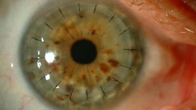 La Pampa alcanzó la lista cero en córneas