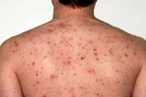 Sarampión: continúa el alerta por los casos locales