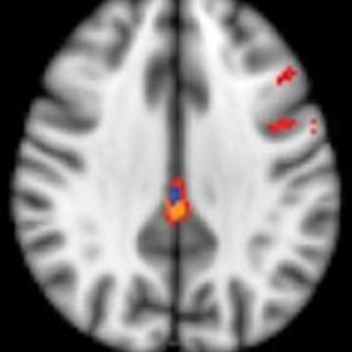 PREVENTING ALZHEIMER