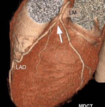 CARDIAC COMPUTED TOMOGRAPHY: An example of a potentially life-threatening coronary artery plaque fou